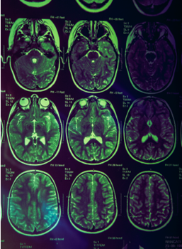 Cannabinoids and Traumatic Brain Injury: A Randomized, Placebo Controlled Trial